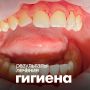 Проблема налета Пристли: как профессиональная гигиена может спасти зубы подростков